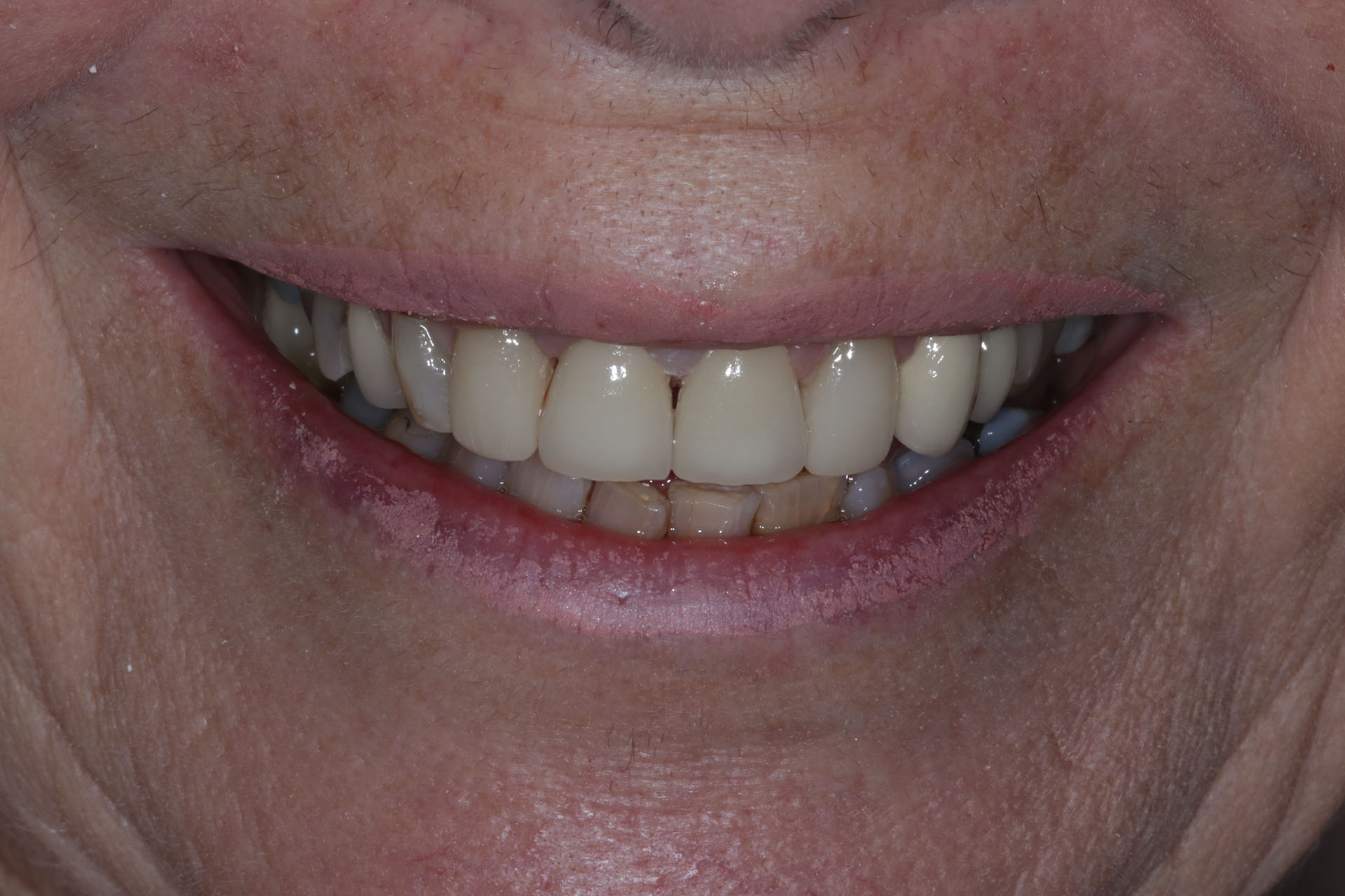 After image